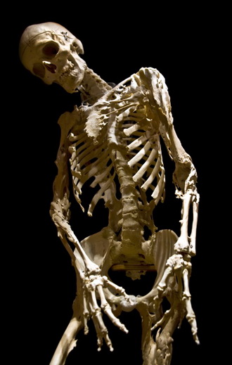 Harry Eastlack's skeleton